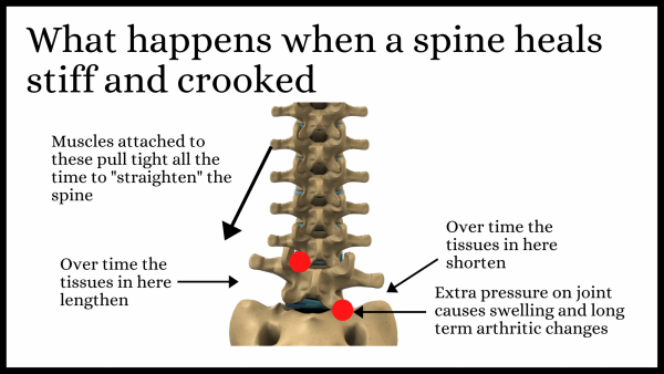 Consequences of an altered spine
