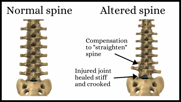 Normal vs altered spine