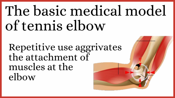 Basic medical model of tennis elbow