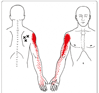 Massage and trigger point therapy for shoulder pain, with self help options   Massage and trigger point therapy for shoulder pain, including how to  treat your own shoulder with massage or trigger