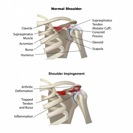 Impingement syndrome medical