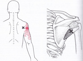 Teres minor trigger points