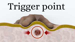 Trigger point