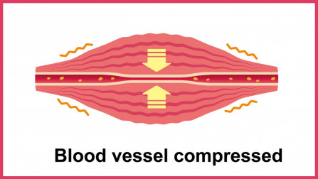 blood vessel compressed