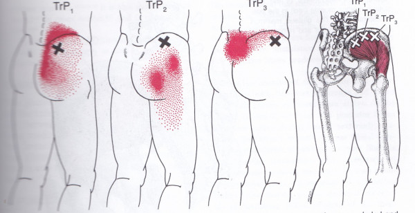 Glute medius muscle with trigger points