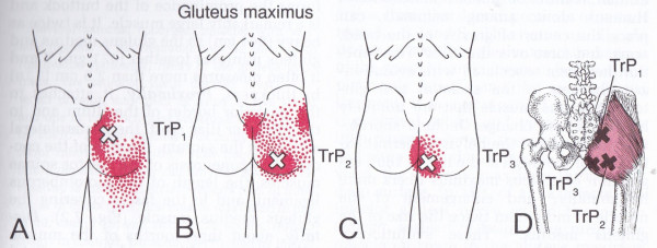 Gluteus Maximus muscle with trigger points