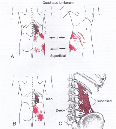 Quadratus lumborum muscles with trigger points